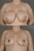 breast-reduction-p24.jpg
