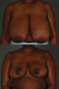 breast-reduction-p26.jpg