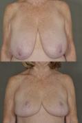 breast-reduction-p28.jpg