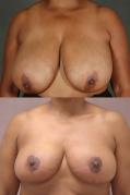 breast-reduction-p3.jpg