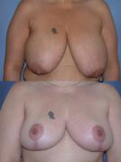 breast-reduction-p32.jpg