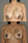 breast-reduction-p5.jpg