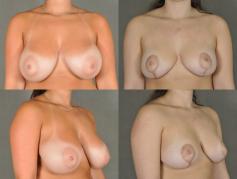 breast-reduction-p6.jpg