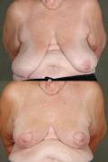 breast-reduction-p7.jpg