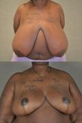 breast-reduction-p8.jpg