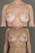 breast-revision-and-lift-p1.jpg