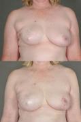 breast-revision-p2.jpg