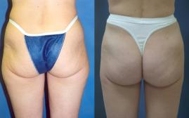 buttock-augmentation-and-liposuction-p1.jpg