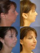 chin-augmentation-and-liposuction-p1.jpg