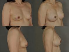 expander-breast-reconstruction-tummy-tuck-p9.jpg