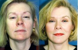 face-and-neck-lift-eyelid-surgery-p1.jpg