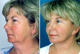 face-and-neck-lift-eyelid-surgery-p10.jpg