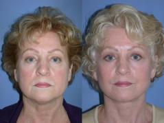 face-and-neck-lift-eyelid-surgery-p11.jpg
