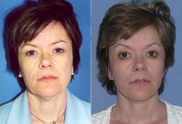 face-and-neck-lift-eyelid-surgery-p2.jpg