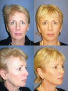 face-and-neck-lift-eyelid-surgery-p3.jpg