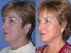 face-and-neck-lift-eyelid-surgery-p4.jpg
