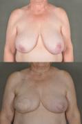 latissimus-flap-breast-reconstruction-p1.jpg