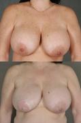 latissimus-flap-breast-reconstruction-p5.jpg