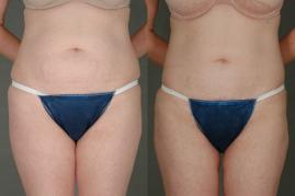 liposuction-p1.jpg