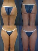 liposuction-p2.jpg
