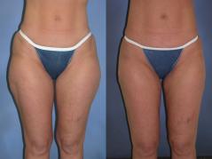 liposuction-p3.jpg