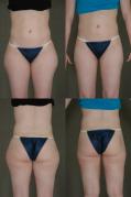 liposuction-p6.jpg