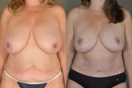 mommy-makeover-tummy-tuck-and-breast-reduction-p1.jpg