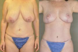 mommy-makeover-tummy-tuck-liposuction-and-br-p1.jpg