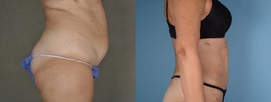 Abdominoplasty (tummy tuck) and liposuction