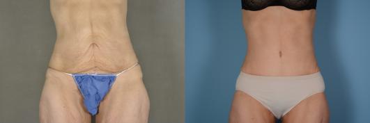 Abdominoplasty (tummy tuck) and body contouring after massive weight loss