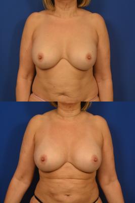 Breast Augmentation 