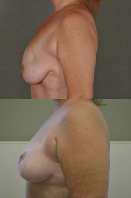 Oncoplastic breast reduction