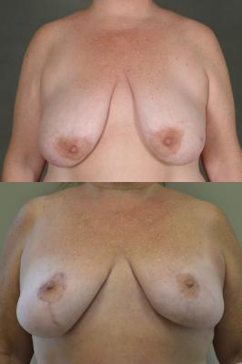 Oncoplastic breast reduction