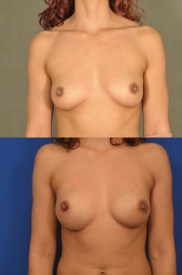 Expander breast reconstruction