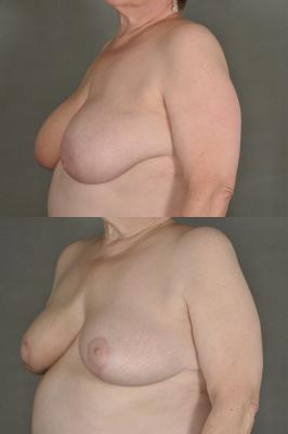 Oncoplastic breast reduction