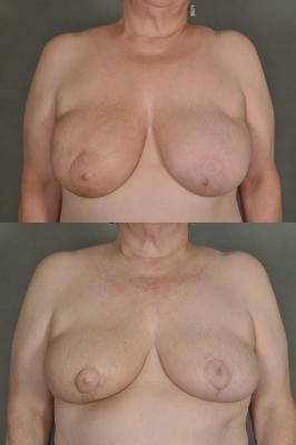 Oncoplastic breast reduction