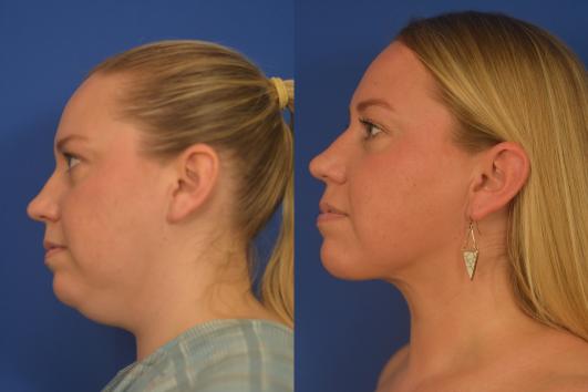 Chin liposuction