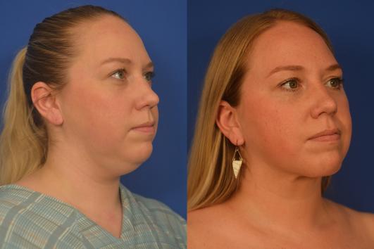 Chin liposuction