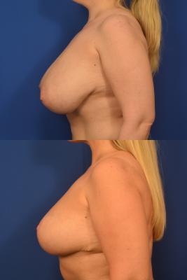 Bilateral Breast Reduction 