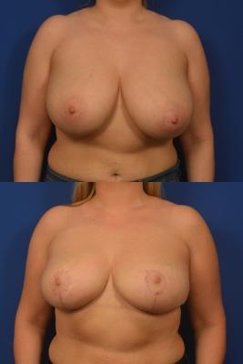 Bilateral Breast Reduction 