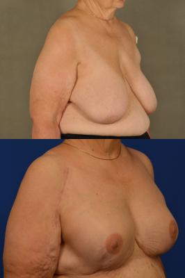 Expander breast reconstruction 