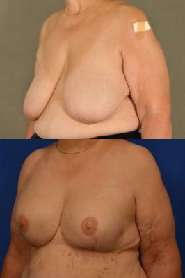 Expander breast reconstruction 