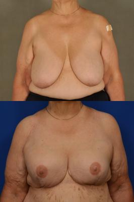 Expander breast reconstruction 