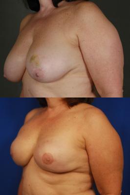 Expander breast reconstruction 