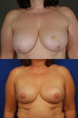 Expander breast reconstruction 