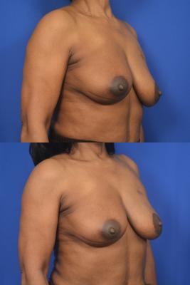 Left breast reduction for symmetry 