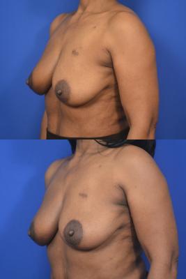 Left breast reduction for symmetry 
