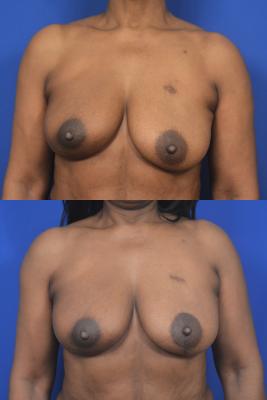 Left breast reduction for symmetry 
