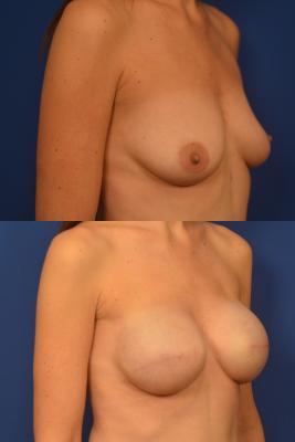 Breast Reconstruction