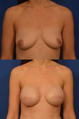 Breast Reconstruction